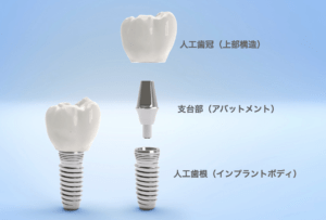 インプラントメーカーが製作する人口歯