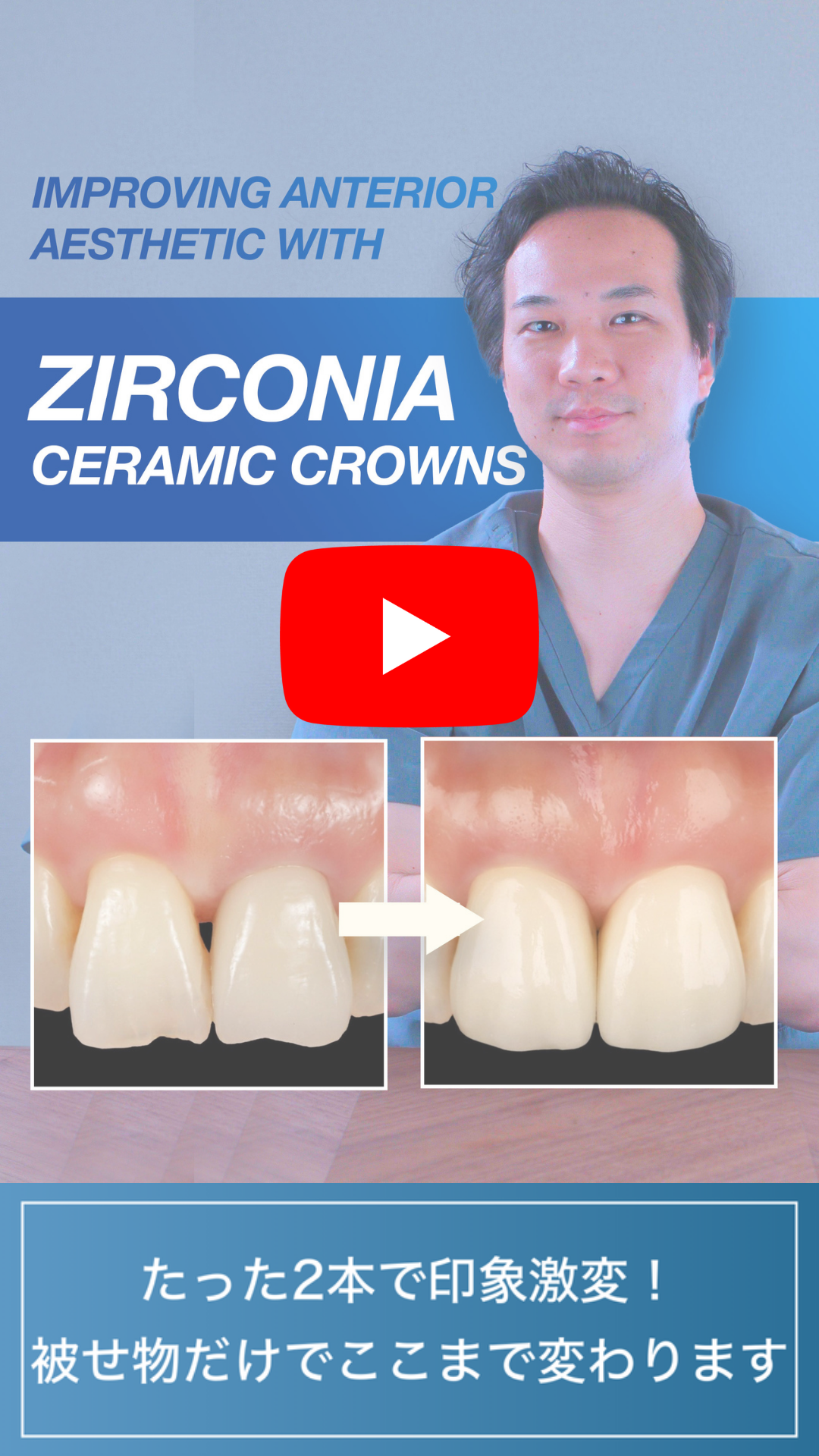 ジルコニア症例