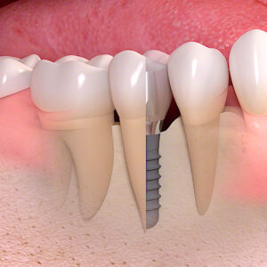 第二の永久歯と呼ばれているインプラント