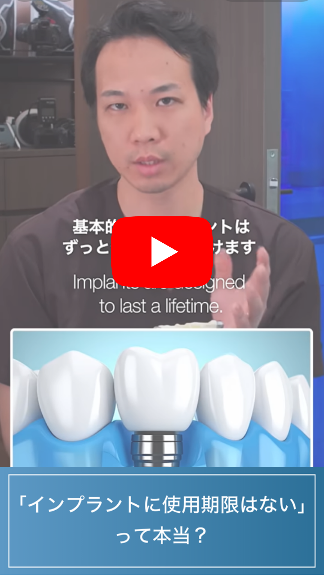 インプラントの寿命