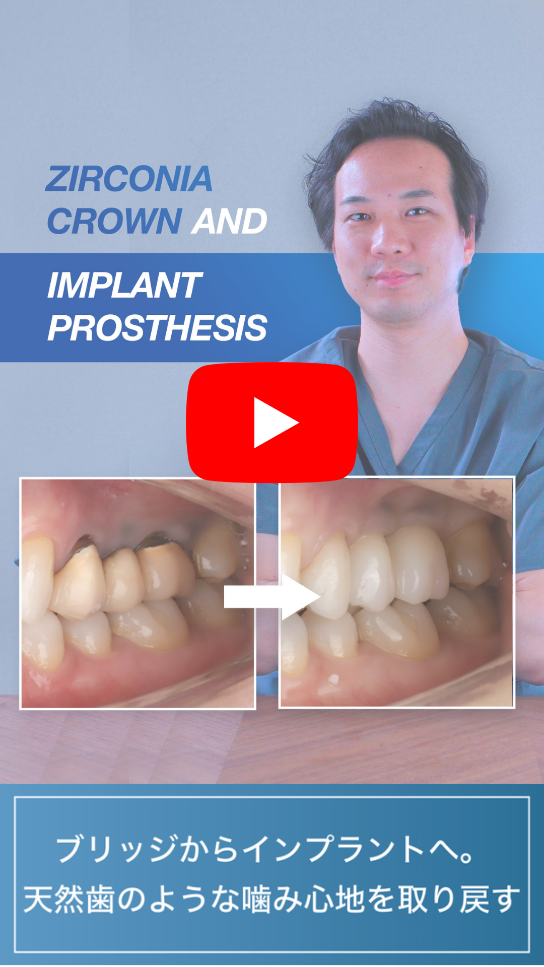 ブリッジからインプラントへ