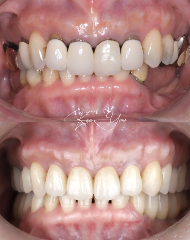 Keywords
-Digital workflow
-Crown lengthning
-Prosthetic-Driven Planning

The power of the digital workflow in dental implants lies in its ability to enhance precision, efficiency, and patient outcomes through advanced technology. 
Implant position and GBR strategy aligns with the final prosthetic design, optimizing aesthetics and function.
Wide range 3DCT anatomical image enable us to simulate modification of occlusal plane for better oral function.

For surgical planning, CT DICOM data for 3 dimensional bone and teeth image and STL data for 3D intraoral image were marged. Surgical guide was made with 3D printer for accurate implant placement.

長期間にわたる臼歯部の欠損により咬合機能が低下していた患者に対し、咬合平面の是正、適切なアンテリアガイドの構築、インプラント補綴治療を行い、審美と機能を回復した症例。
広い撮影範囲（FOV）のCTデータと口腔内スキャンデータをマッチングさせ、理想的補綴形態から、インプラント埋入ポジションと顎堤増大の戦略をたて、効果的効率的に治療を行った。

#aestheticdentist #インプラント #審美歯科 #歯周病治療 #セラミック治療 #歯を綺麗に #toothpreparation #periodontal #dentallaboratory #crownlenthening #dentalimplant #implant #digitaldentistry
#aestheticdentistry #smilemakeover #ceramiccrowns #fullmouth 
#dentalphoto
#oralsurgery
#implantology
@lotus_fudomae