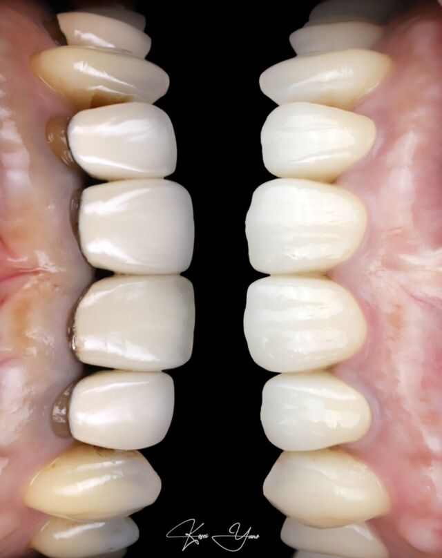 Keywords
-Digital workflow
-Crown lengthning
-Surgical guide (Guided surgery)

The power of the digital workflow in aesthetic dentistry lies in its ability to enhance precision, efficiency, and patient outcomes through advanced technology.

Optimal restorative outcome can be achieved by optimizing the periodontal tissue environment.

Incisal edge position was determined with patient's lip line and ideal margin line was determined.

In order to get simmetry and continuity of teeth and gingiva, crown lengthning was performed.

For surgical planning, CT DICOM data for 3 dimensional bone and teeth image and STL data for 3D intraoral image were marged. Surgical guide was made with 3D printer for accurate crown lengthning procedure.

不適合補綴装置とガミースマイルによる審美障害を改善するために、クラウンレグスニングと審美補綴治療を行なった症例。
リップラインと前歯(歯肉と歯)のDisplayから、理想的切縁ラインとマージンラインを決定した。再現性の高い歯周外科治療を行うために、CTデータと口腔内スキャンデータをマッチングさせ、サージカルガイドを使用した歯周外科治療を行った。

#審美歯科 #digitaldentistry 
#aestheticdentistry #smilemakeover 
#aestheticdentist #インプラント #審美歯科 #歯周病治療 #セラミック治療 #歯を綺麗に #toothpreparation #periodontal #dentallaboratory #crownlenthening #dentalimplant #implant 
#ceramiccrowns 
#dentalphoto #oralsurgery

@lotus_fudomae