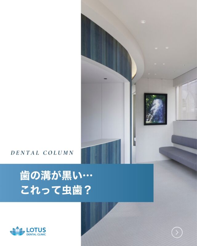 🦷 歯の溝が黒い…これって虫歯？

歯を鏡で見たときに、奥歯の溝が黒くなっているのを見つけて「虫歯かも？」と不安になったことはありませんか？

実は、歯の溝が黒く見えるからといって必ずしも虫歯とは限りません。
では、黒くなる原因にはどんなものがあるのでしょうか？

🦷考えられる原因
✔ 着色汚れ（ステイン）
コーヒーやお茶、赤ワインなどの飲食物による着色が溝に沈着することがあります。これは歯の表面に付着するもので、クリーニングで除去できる場合が多いです。

✔ 溝が深い自然な形状
生まれつき歯の溝が深い人は、その部分が影になり黒く見えることがあります。

✔ 初期虫歯（要注意）
歯の表面のエナメル質が脱灰（カルシウムが溶け出す現象）すると、黒や茶色っぽく見えることがあります。
この段階では痛みはありませんが、進行すると本格的な虫歯に発展する可能性があります。

✔ 過去の虫歯治療跡
過去に治療した歯の詰め物の周囲が黒く見えることがあります。

🦷どう判断すればいい？
・ 黒い部分が広がってきた、またはザラザラしている → 虫歯の可能性が高い
・ 食べ物が詰まりやすくなったり、しみる感覚がある → 早めの受診をおすすめ

見た目だけでは判断が難しいため、定期的な歯科検診でチェックすることが大切です。
 早めの診断で適切なケアを行うことで、虫歯の進行を防ぐことができます。

気になる症状があれば、お気軽にご相談ください。

📞 まずは無料相談を！
お電話またはWebから簡単にご予約いただけます。

・・・・・・・・・・・・・・

🌿 LOTUS DENTAL CLINIC 不動前では、
患者様一人ひとりに寄り添った治療プランを提供し、最先端の医療設備で高品質な治療を行っています！

📍 アクセス
🏡 〒141-0031 東京都品川区西五反田3丁目13-11
🚶‍♀️ 不動前駅 徒歩2分／目黒駅 徒歩10分
🚗 首都高環状線「五反田出口」すぐそば

お口の健康を守る第一歩を、LOTUS DENTAL CLINIC 不動前で！ 

#lotusdentalclinic #品川区 #不動前 #武蔵小山 #歯科 #歯医者 #歯科医院
#虫歯チェック #歯の着色 #定期検診 #予防歯科 #虫歯予防