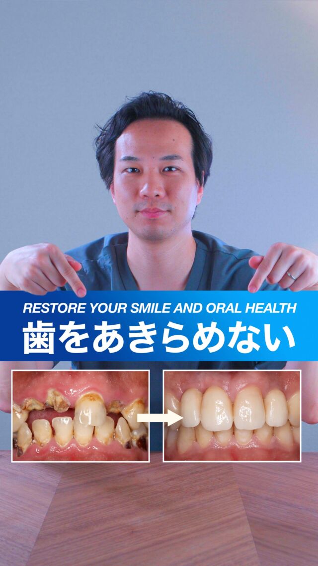 Dentist: @kosei_yano_phd 

歯がボロボロでどうしていいかわからないという方がいらっしゃいました。
この方は実は20代の男性の方で海外に出張に行かれて帰ってきた頃には
このような状態になっていたと非常にたくさんのむし歯があって
ある先生だったらですね
全て抜いてインプラントにしようと思うほど悪い状態でした
けれども当院ではできるだけ残せる歯は残すということで決意しまして
実はこの歯を3本だけ抜いてここにインプラント治療をしまして
残りのところに1本だけジルコニアクラウンを入れました
残りのこれらの歯はですね
全てダイレクトボンディングというレジン治療で
治療することができました。
ですので今回ですね
全体的に問題があったところも全て修復できて
抜かないといけないところは抜きましたけれども
また笑顔を取り戻すことができたと思います
むし歯にならない環境を整えていくことが一番大事かなと思います。

When your teeth are in terrible shape and you don’t know what to do…
This patient—a man in his 20s—returned from an overseas business trip with severe dental issues and numerous cavities.
In fact, the condition was so bad that another dentist might have opted to extract all the teeth and replace them with implants.
But at our clinic, we’re committed to preserving natural teeth whenever possible.
We decided to extract just three teeth and placed implants in those areas.
One remaining tooth received a zirconia crown.
The rest were treated with a resin technique called direct bonding.
We were able to restore all the problem areas.
While the necessary extractions were done, the rest of the smile was saved—and more importantly, restored.
Now, he’s able to smile again with confidence.
The key is creating an environment where cavities can’t form in the first place.

#dentaltransformation #smilemakeover #implants #directbonding #zirconiacrown #toothpreservation #beforeandafter #tokyodental #lotusdentalclinic #虫歯 #歯科治療 #インプラント #ダイレクトボンディング #ジルコニアクラウン