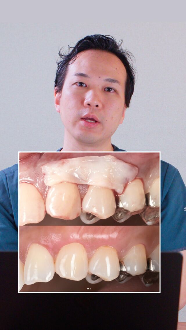 【症例紹介】知覚過敏の原因は“歯ぐき下がり”？🦷
「冷たいものがしみる…」
そんな知覚過敏の症状で来院された患者様。

よく見ると、歯ぐきが下がって歯の根元がむき出しになっており、
さらに表面が削れてえぐれてしまっていました。

🔍 治療方法は“歯ぐきを戻す再生治療”
今回は、「結合組織移植術（混合被覆術）」を選択。

👄 上あごから歯ぐきを採取し、
👄 歯ぐきが下がっていた部分に滑り込ませて縫合
👄 組織の再生を促し、自然なボリュームと位置に回復！

術後は、しっかりと歯ぐきが元の位置まで戻り、知覚過敏の症状も改善✨
見た目も自然に整い、患者様にも大変ご満足いただけました。

歯ぐきの下がりや知覚過敏でお悩みの方、
再生治療という選択肢があることを、ぜひ知っていただきたいです。

・・・・・・・・・・・・・

📍 LOTUS DENTAL CLINIC 不動前
🏡 東京都品川区西五反田3丁目13-11
🚶‍♀️ 不動前駅 徒歩2分／目黒駅 徒歩10分

監修：@kosei_yano_phd

#lotusdentalclinic #知覚過敏 #歯ぐき下がり #再生治療 #歯周形成外科
#結合組織移植術 #歯肉移植 #症例紹介 #審美歯科 #不動前 #品川区