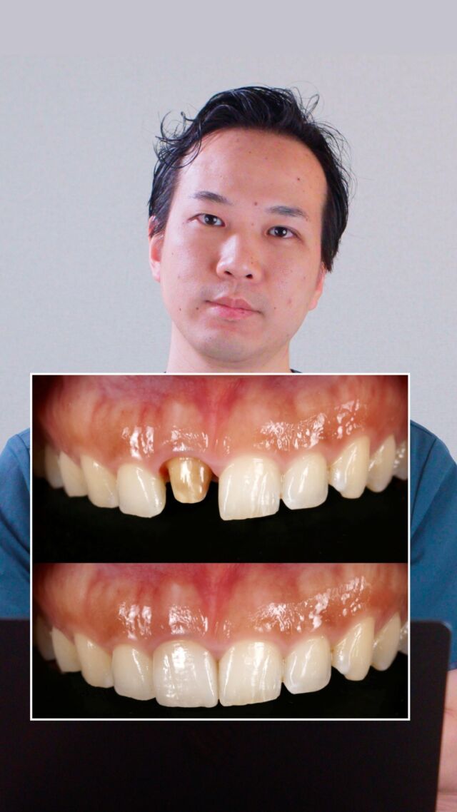 🦷【難しい前歯の“片側だけ”やり直し】
今回は「昔治療した前歯が取れてしまった」とご来院された患者さまの症例です。

隣の歯はそのままに、取れた1本だけを再治療したいというご希望でしたが──
実はこのような「片側だけ」の前歯治療は非常に繊細で難易度が高い治療になります。

ポイントは【左右対称】の再現。
✔️ 両隣の角の尖り方
✔️ 表面に見えるしわ模様
✔️ そしてなにより、微妙な“色味”

これらを忠実に再現しなければ、違和感が残ってしまいます。

しかし当院の技工士との連携により、自然な仕上がりに✨
「どこを治療したのかわからない」レベルの審美的回復を目指しています。

👀症例のビフォーアフターは、ぜひリール動画でご覧ください！

・・・・・・・・・・・・・・

📍 アクセス
🏡 〒141-0031 東京都品川区西五反田5-10-6
🚶‍♀️ 東急目黒線「不動前駅」徒歩2分

監修：@kosei_yano_phd

#ロータスデンタルクリニック
#歯科症例 #前歯の治療 #審美歯科 #前歯補綴 #自然な仕上がり
#歯科医師 #歯科衛生士 #歯科助手 #五反田 #不動前 #目黒区の歯医者