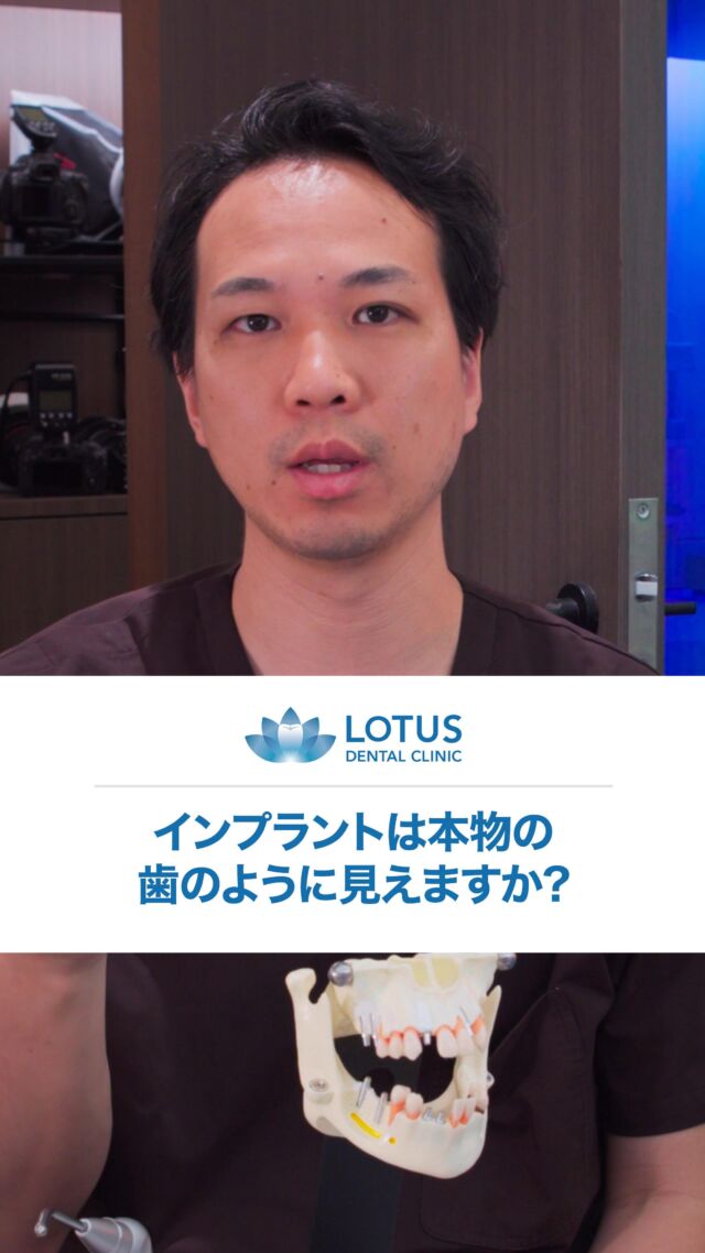 インプラントは本物の歯のように見えますか?

Do implants look like real teeth?

インプラントも天然の歯と見分けがつかないほど綺麗に作ることができます。

骨をしっかり作って歯ぐきも再生させたり、綺麗な被せ物を作ることによって、できるだけ天然の歯に近づける努力をしています。

Implants can be made so beautifully that they are indistinguishable from natural teeth.

We strive to make implants as close to natural teeth as possible by building strong bone, regenerating gums, and creating beautiful caps.

📍 LOTUS DENTAL CLINIC 不動前

🏡 東京都品川区西五反田3丁目13-11

🚶‍♀️ 不動前駅 徒歩2分／目黒駅 徒歩10分