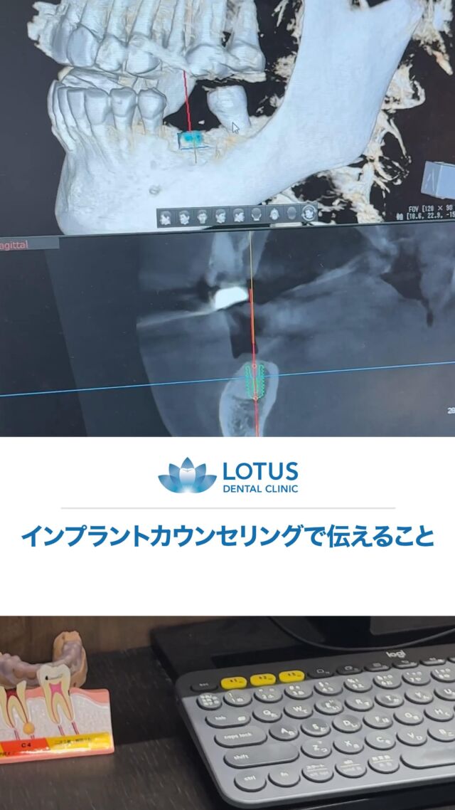 インプラントのカウンセリングでは、インプラントの治療の方法、そうして治療期間、ご費用、その他リスクなどを話していきます。

その方が初めてのインプラントの場合は、しっかり深く説明していきます。

不安が結構多いと思いますので、手術の内容詳細まで話していきますけれども、実際ですねインプラント治療はすぐ終わることが多いです。

これが実際のインプラントなんですけれども、すごく小さいですよね。

幅が4mmで、長さが大体10mmくらいです。

ですので、手術の侵襲性もそんなに高くなくて、手術時間も大体30分くらいで終わることが多いです。

手術後の痛みもそこまで出ませんので、そういったところ安心していただきたいなと思っております。

何回もインプラントをやっている方は、その辺りの説明を簡単にさせていただいてまして、具体的なインプラントの埋入のシミュレーションをお伝えします。

こちらの方は、左下の奥歯にインプラントを埋入する計画なんですけれども、骨が無いところに骨を作って骨が治ってきたので、理想的な位置にインプラントを埋入する計画です。

その他、費用ですね、そしてどれくらいの治療期間がかかるかということを説明しています。