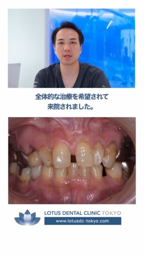 ✨【笑えなかった口元に、自信を取り戻す】

「前歯のすき間が気になって思い切り笑えない…」
そんなお悩みを抱えてご来院された50代女性の症例をご紹介します。

初診時は、
✔ 古くなった金属の被せ物
✔ 複数の虫歯
✔ 劣化した詰め物
✔ 前歯のすき間（正中離開）
など、お口全体にさまざまな問題が見られました。

そこで当院では、お口全体を丁寧に診査・診断したうえで、
🦷 全体的な矯正治療
🦷 虫歯治療
🦷 最小限のインプラント治療
🦷 セラミック治療
を組み合わせた包括的な治療をご提案しました。

すべての歯を治療するのではなく、残せる歯はできる限り活かすことも大切なポイントです。
治療後は、前歯のすき間が改善されただけでなく、噛み合わせも整い、「何でも噛めるようになった」と大変喜んでいただきました。
リップラインの変化からも、お口元の印象が大きく変わったことが分かります✨

「歯並びや見た目が気になって笑顔に自信が持てない…」
そんなお悩みも、お口全体を考えた治療で改善できる可能性があります。
当院では、一人ひとりのお口の状態やご希望に合わせた治療計画をご提案しています。

・・・・・・・・・・・・・・

LOTUS DENTAL CLINIC 不動前では、患者様一人ひとりに寄り添った治療プランを提供し、最先端の医療設備で高品質な治療を行っています。

📞 まずは無料相談をご予約ください！
お電話またはWebから簡単にご予約いただけます。

📍 アクセス
〒141-0031 東京都品川区西五反田3丁目13-11
🚶‍♀️ 不動前駅 徒歩2分／目黒駅 徒歩10分
🚗 首都高環状線「五反田出口」すぐそば

お口の健康を守る第一歩を、LOTUS DENTAL CLINIC 不動前で！ 🦷💖

#LOTUSDENTALCLINIC #LOTUSDENTALCLINIC不動前 #症例紹介 #正中離開 #セラミック治療 #矯正治療 #インプラント #審美歯科 #全顎治療 #品川区 #不動前 #五反田 #目黒