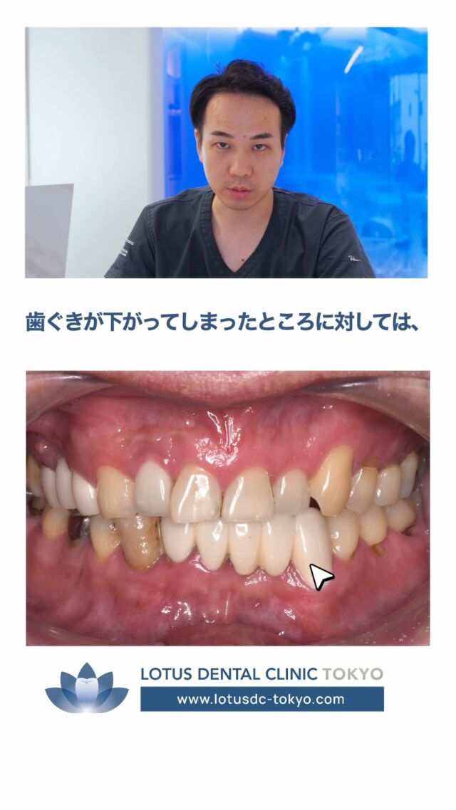 🦷【たった1年でここまで変わる】

「若々しい口元になりたい」
そんな想いでご来院された50代の患者様の症例をご紹介します。

初診時は、
✔ 虫歯
✔ 歯並びの乱れ
✔ 古い詰め物
✔ 歯ぐきからの排膿
✔ 歯ぎしりによるダメージ

など、お口全体にさまざまな問題が見られました。

そこで当院では、まず虫歯治療を行い、その後、お口全体のバランスを考えながら最小限のインプラント治療とセラミック治療をご提案。

さらに、歯ぐきが下がってしまった部分には再生治療を組み合わせることで、見た目だけでなく健康面にも配慮した包括的な治療を行いました。

その結果、約1年で治療が完了。
患者様にも大変お喜びいただくことができました✨

口元は、お顔全体の印象を左右する大切な要素です。
「歯がボロボロだから…」と諦める前に、一度ご相談ください。

当院では、一人ひとりのお口の状態を丁寧に診査・診断し、できる限り歯を残しながら、お口全体の健康と機能、美しさのバランスを考えた治療をご提案しています。

・・・・・・・・・・・・・・

LOTUS DENTAL CLINIC 不動前では、患者様一人ひとりに寄り添った治療プランを提供し、最先端の医療設備で高品質な治療を行っています。

📞 まずは無料相談をご予約ください！
お電話またはWebから簡単にご予約いただけます。
　
📍 アクセス
〒141-0031 東京都品川区西五反田3丁目13-11
🚶‍♀️ 不動前駅 徒歩2分／目黒駅 徒歩10分
🚗 首都高環状線「五反田出口」すぐそば

お口の健康を守る第一歩を、LOTUS DENTAL CLINIC 不動前で！ 🦷💖

#LOTUSDENTALCLINIC #LOTUSDENTALCLINIC不動前 #症例紹介 #全顎治療 #セラミック治療 #インプラント #再生療法 #審美歯科 #歯周病治療 #品川区 #不動前 #五反田 #目黒