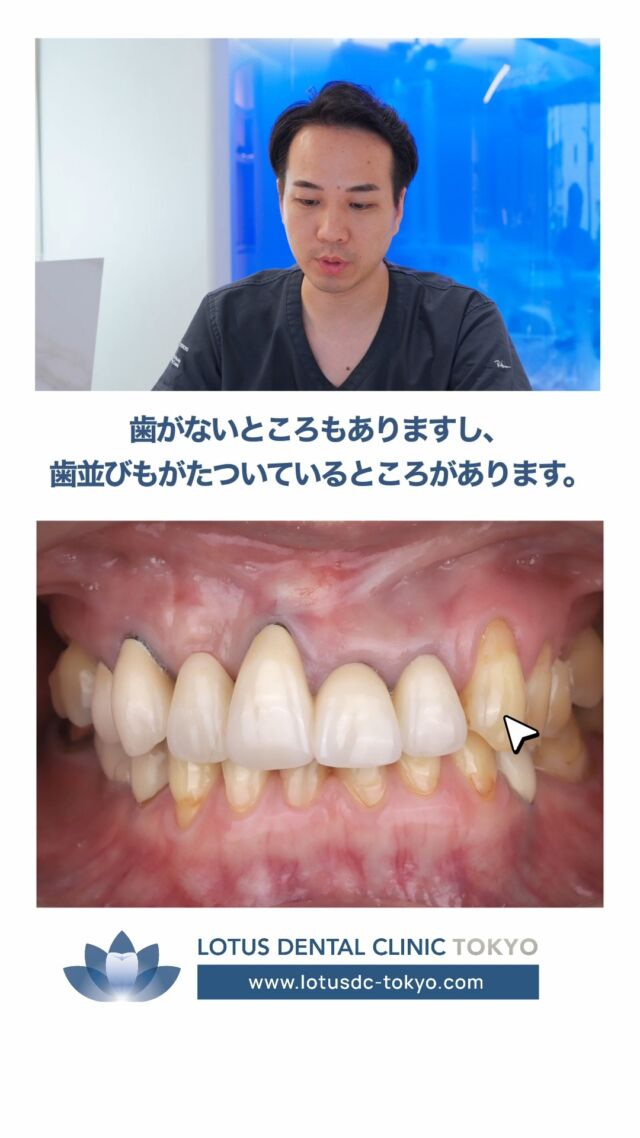 ✨【お口元のコンプレックスを、笑顔に変える】

「人前で口を開けて笑えない…」

そんな強いコンプレックスを抱えてご来院された50代女性の症例をご紹介します。

初診時のお口には、

✔ 歯の長さのばらつき
✔ 歯を失っている部分
✔ 歯並びの乱れ
✔ 歯のすり減り
✔ 古い詰め物や虫歯

など、お口全体にさまざまな問題がありました。

そこで当院では、お口全体を精密に診査・診断し、

🦷 虫歯治療
🦷 古い詰め物のやり替え
🦷 歯周組織の再生治療
🦷 インプラント治療

を組み合わせた包括的な治療を行いました。

治療後は、お口元のバランスが整い、機能面だけでなく見た目の印象も大きく改善。

患者様からは「自信を持って笑えるようになった」と大変喜んでいただきました。

口元は、お顔全体の印象を左右する大切な要素です。

「歯がすり減ってきた」
「歯並びや見た目にコンプレックスがある」
「できるだけ自然な見た目で治療したい」

そのようなお悩みをお持ちの方は、一人で抱え込まず、ぜひ一度ご相談ください。

当院では、お口全体の健康・機能・審美性を考慮した治療計画をご提案しています。

・・・・・・・・・・・・・・

LOTUS DENTAL CLINIC 不動前では、患者様一人ひとりに寄り添った治療プランを提供し、最先端の医療設備で高品質な治療を行っています。

📞 まずは無料相談をご予約ください！
お電話またはWebから簡単にご予約いただけます。
　
📍 アクセス
〒141-0031 東京都品川区西五反田3丁目13-11
🚶‍♀️ 不動前駅 徒歩2分／目黒駅 徒歩10分
🚗 首都高環状線「五反田出口」すぐそば

お口の健康を守る第一歩を、LOTUS DENTAL CLINIC 不動前で！ 🦷💖

#LOTUSDENTALCLINIC #LOTUSDENTALCLINIC東京 #症例紹介 #全顎治療 #インプラント #再生療法 #審美歯科 #歯のすり減り #歯並び #口元改善 #歯科 #歯医者 #品川区 #不動前 #五反田 #目黒